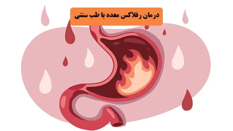 درمان رفلاکس معده در طب سنتی دکتر خیراندیش