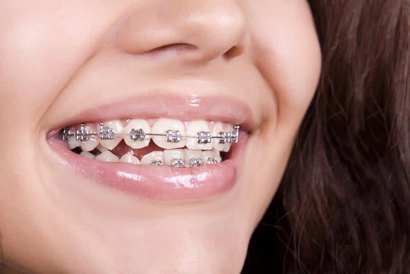 علت سیاه شدن دندان بعد از ارتودنسی