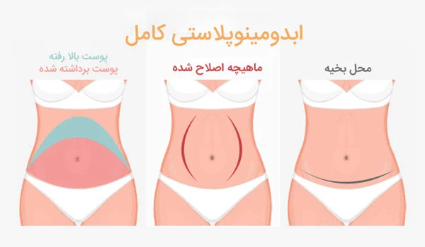 Abdominoplasty absorbable suture