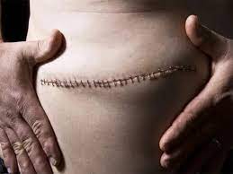 Abdominoplasty absorbable suture