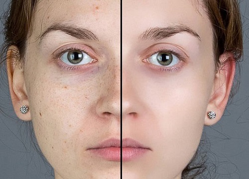 Can facial blemishes be removed with laser?