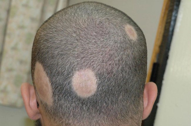 What is the cause of hair loss and is there a cure?