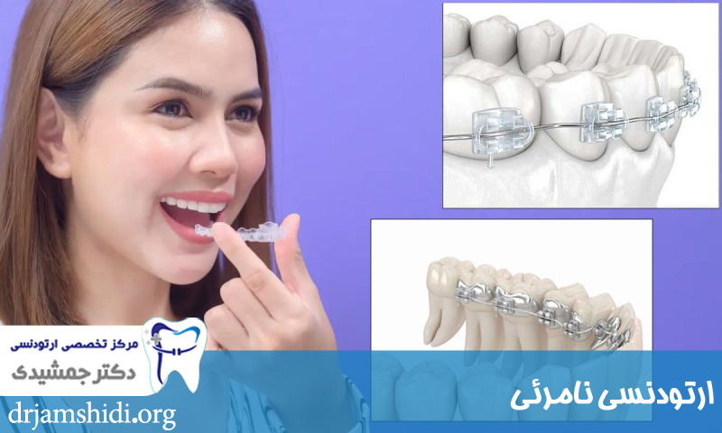 ارتودنسی نامرئی و شفاف ، ارتودنسی بی رنگ ، اینویزیلاین