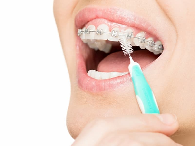 با ارتودنسی روزی چند بار مسواک بزنیم